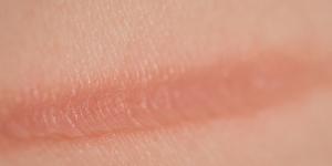 How to Get Rid of Burn Marks on the Skin with Home Remedies