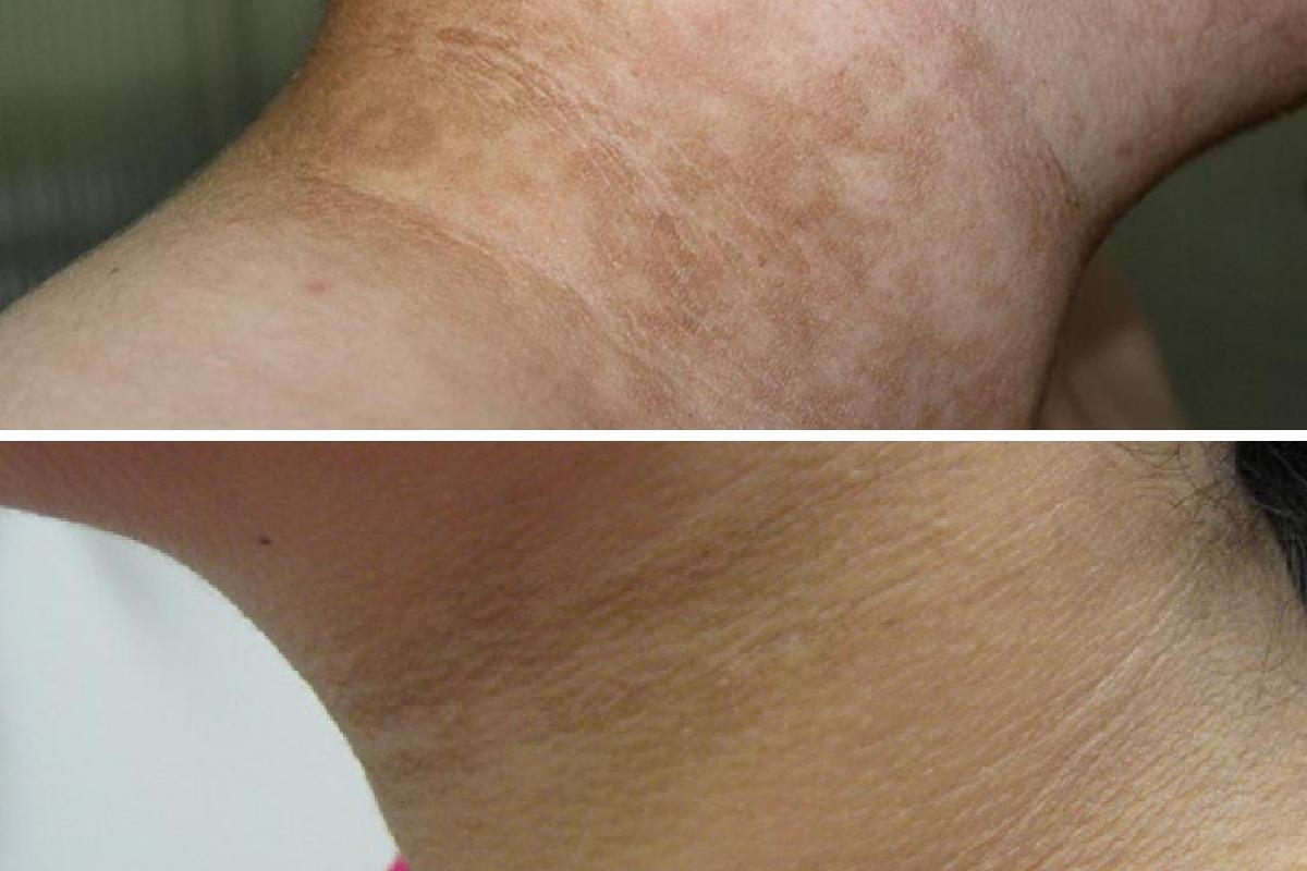 How to Remove Black Stains From the Neck