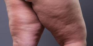 Lipedema - Causes, Symptoms and Treatment