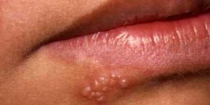 What are the Stages of a Cold Sore?