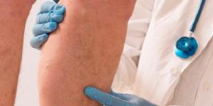 How to Cure Phlebitis with Home Remedies