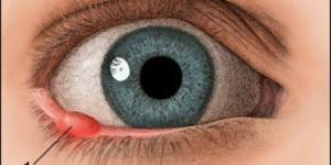 How To Cure A Stye