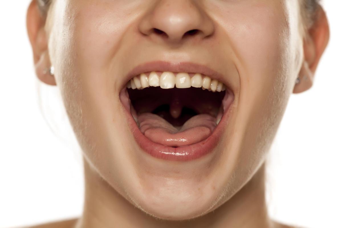 How to Squeeze Out a Salivary Gland Stone