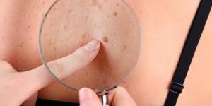 How To Remove Red Moles
