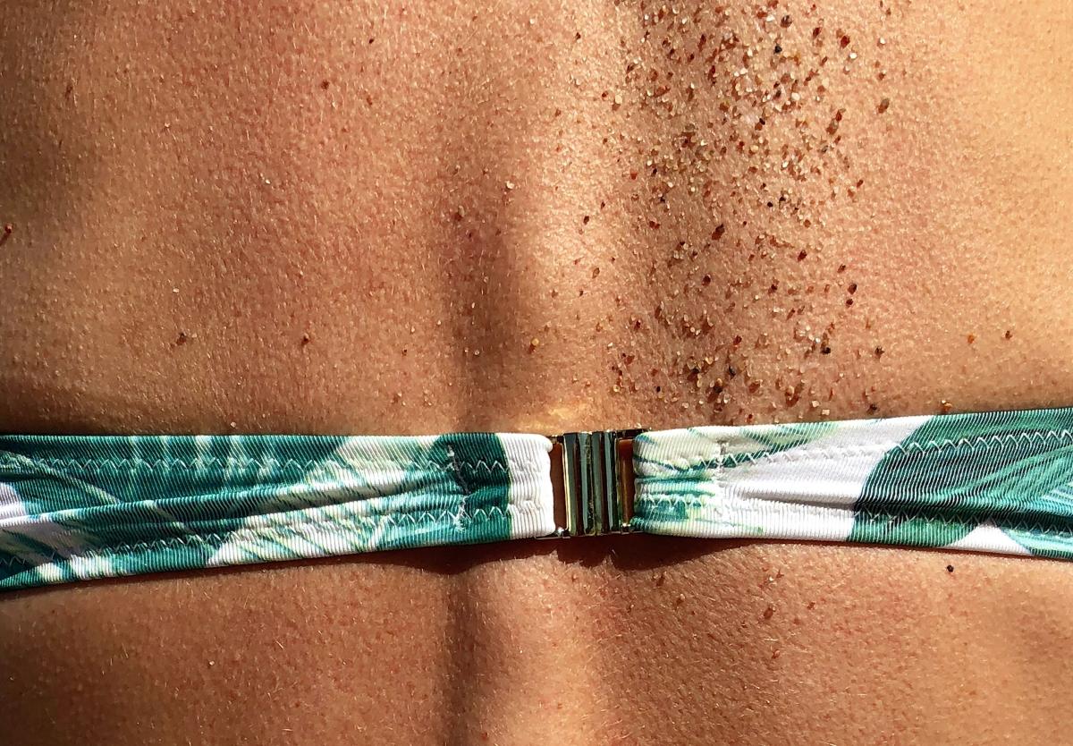 How to Get Rid Of Heat Rash Fast