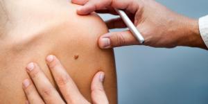 What Causes Red Moles on Your Skin