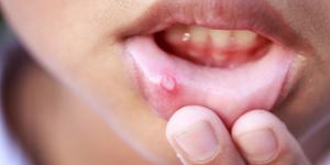What Are the Causes of Mouth Ulcers?