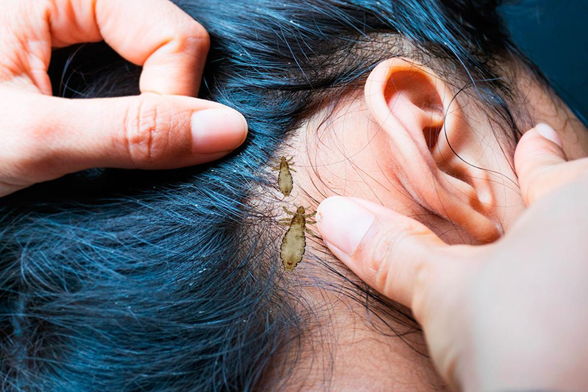 What Does It Mean When You Dream of Lice?