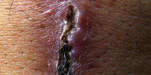 Signs That a Wound Is Infected