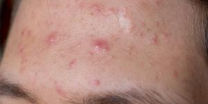 How long Does Eosinophilic Folliculitis last? The Answer