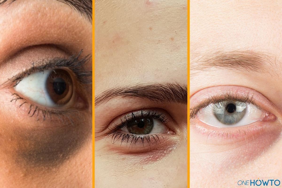 Types of Dark Circles Under the Eyes