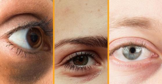 Types of Dark Circles Under the Eyes