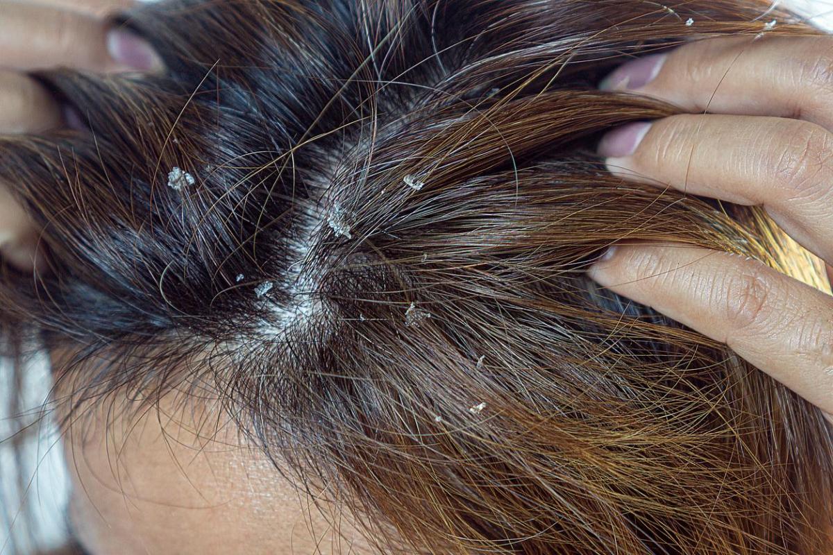 How to Get Rid of Dandruff With Baking Soda