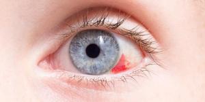 Why is there Blood in my Eye