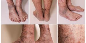 How To Treat Vasculitis In The Legs