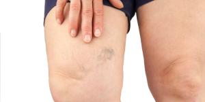 The Best Natural Remedies For Varicose Veins