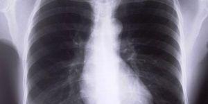 How To Get Rid Of Fluid In Lungs