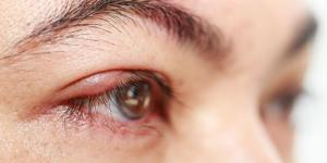 How to Prevent a Stye When You Feel it Coming