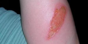 How to Treat Burns with Home Remedies