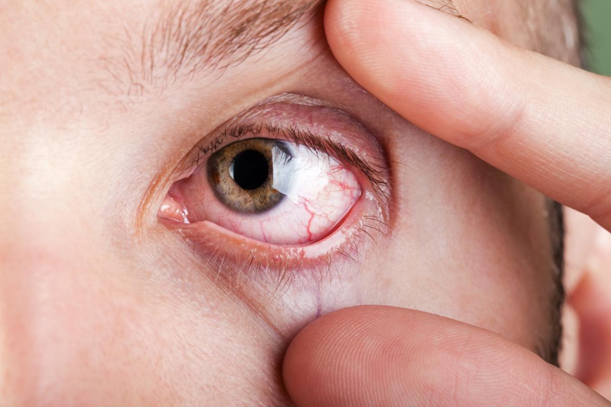 Why Are My Eyes So Dry After I Shower?