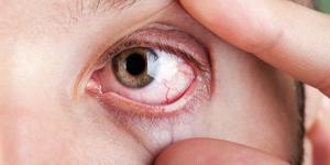 Why Are My Eyes So Dry After I Shower?