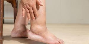 Why Are My Feet and Ankles Swollen? 12 Common Causes