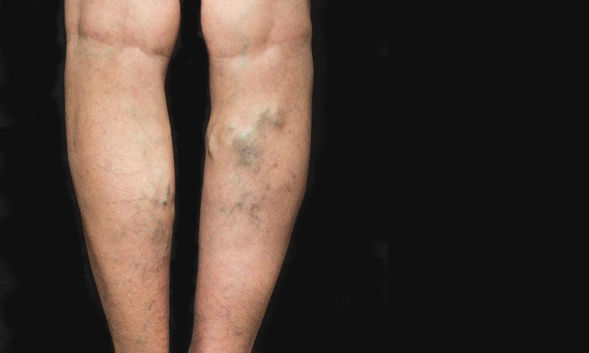 How to Get Rid of Varicose Veins with Coconut Oil