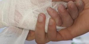 How To Treat A Second Degree Burn