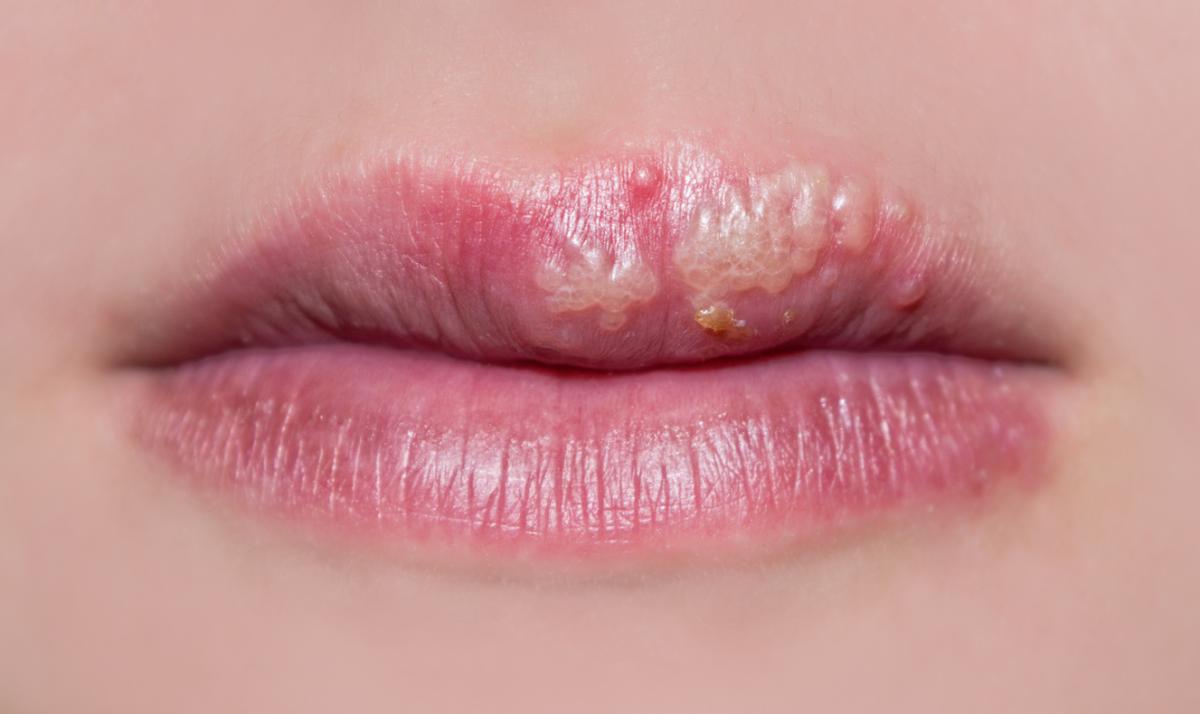 8 Critical Cold Sore Stages
