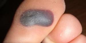 How to Treat a Blood Blister