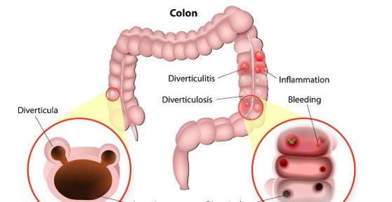 What not to Eat with Diverticulitis