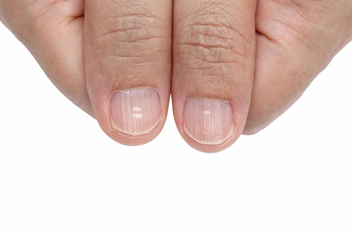 How to Get Rid of White Spots on Nails