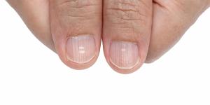 How to Get Rid of White Spots on Nails