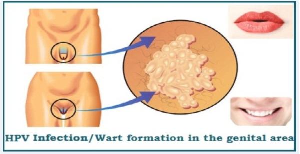 What Are the Symptoms of Human Papillomavirus or HPV - Step 3